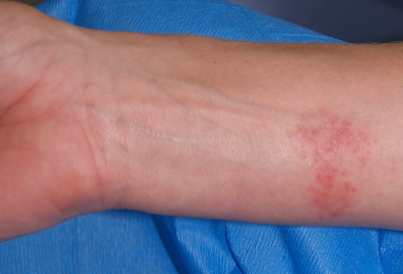 OLYMPUS DIGITAL CAMERA - Dermatitis Academy