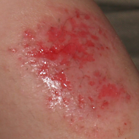 Methylisothiazolinone allergy Archives - Dermatitis Academy