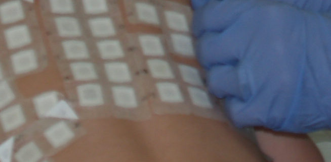 pediatric patch test