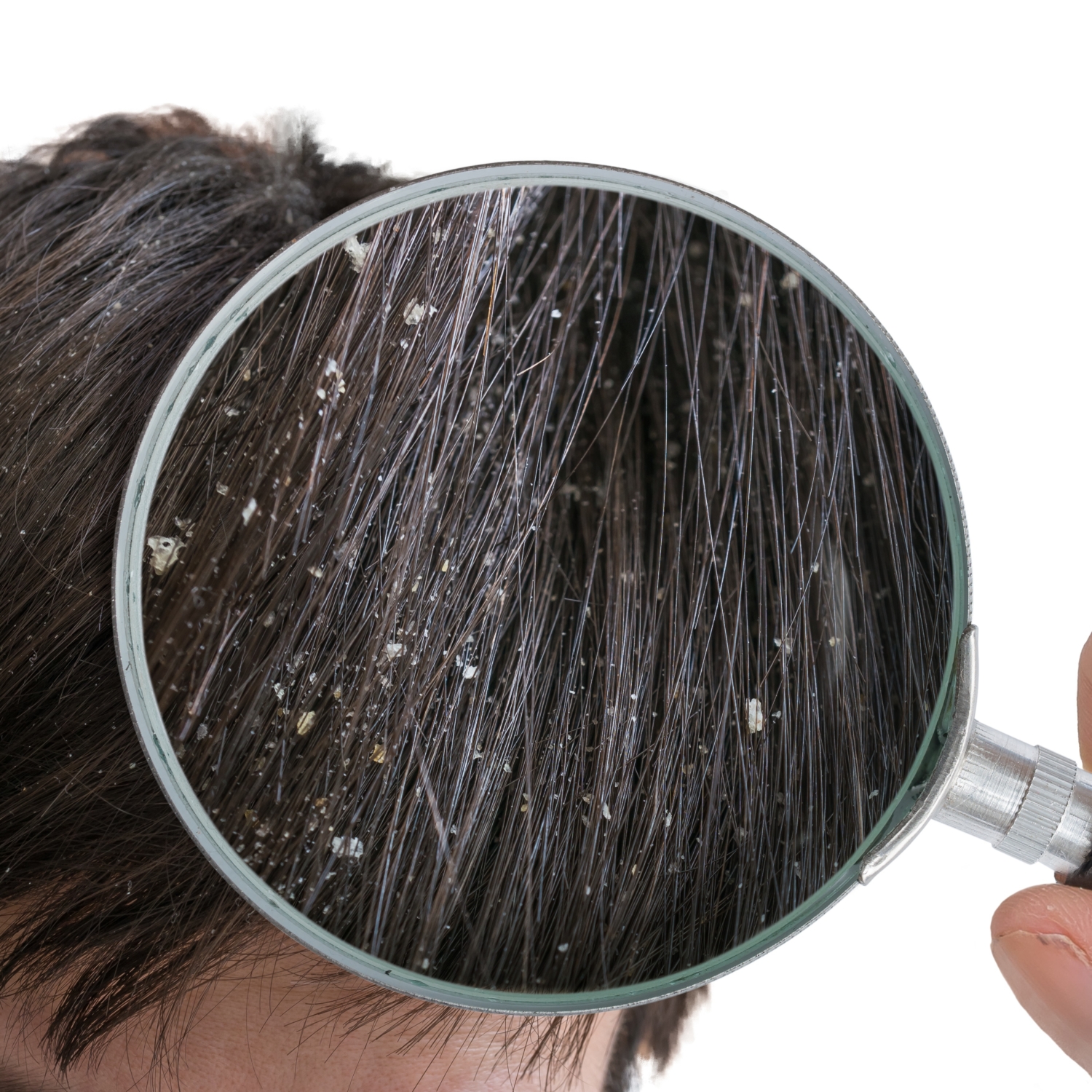 Examiming white dandruff flakes in hair with magnifying glass. Dermatitis Academy