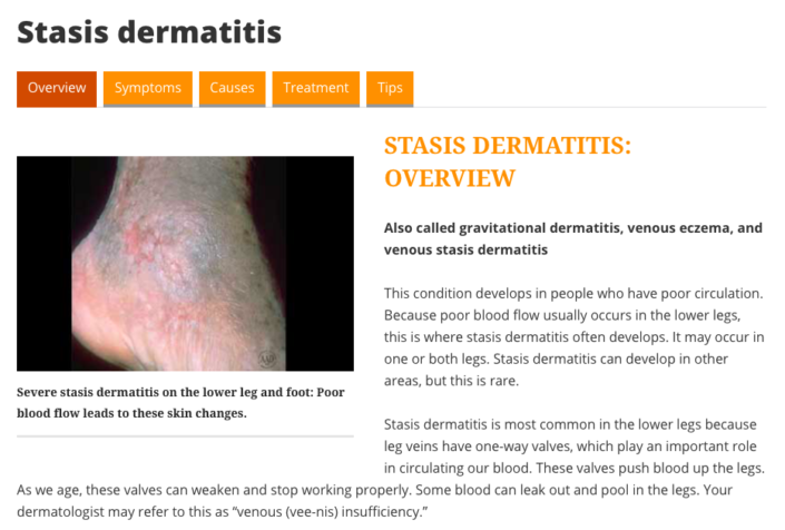 About Stasis Dermatitis - Dermatitis Academy