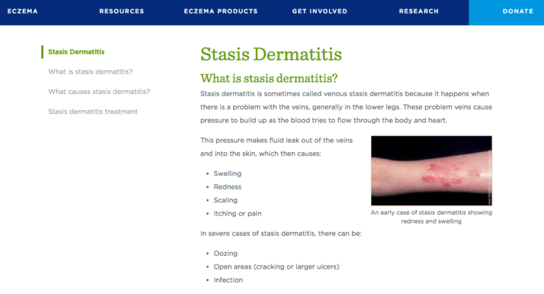 About Stasis Dermatitis - Dermatitis Academy