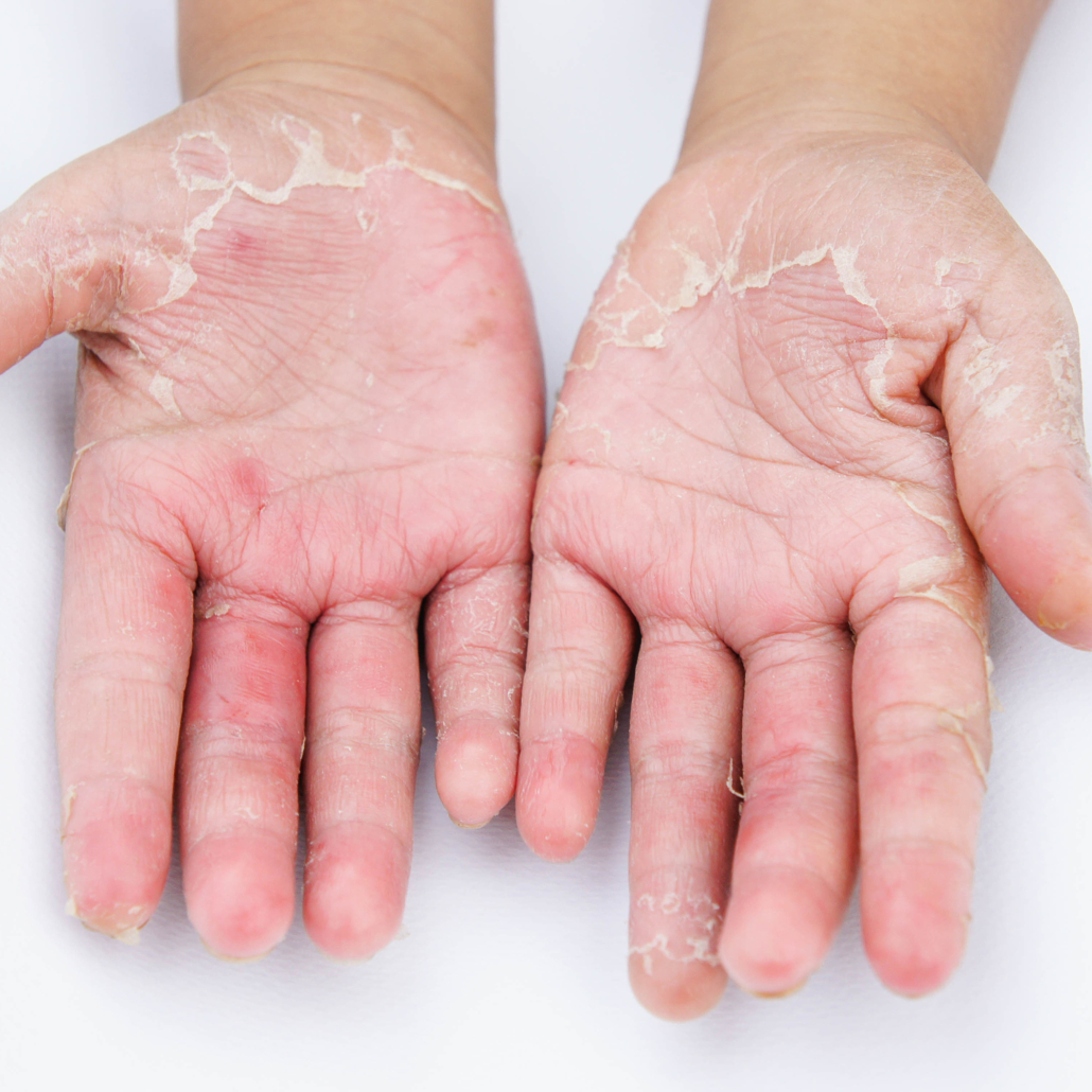 irritantcontactdermatitis-dermatitis-academy